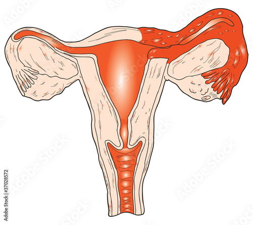 Inflammation of the uterus photo