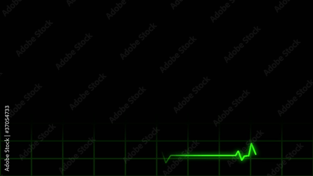 Heart Monitor Lower 3rd Loop Heart Monitor Lower 3rd Loop