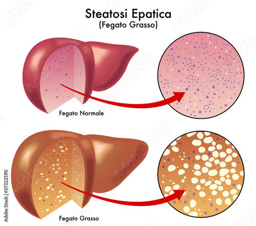 Steatosi epatica