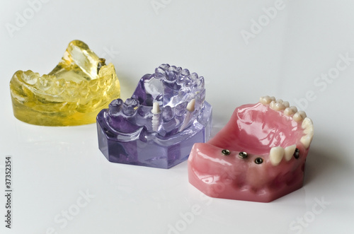 Zahnmedizinische Modelle mit Zahnimplantaten