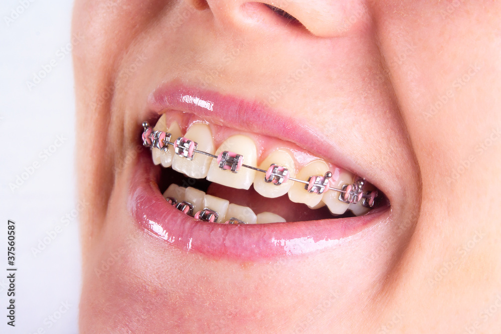 Fototapeta premium teeth with braces