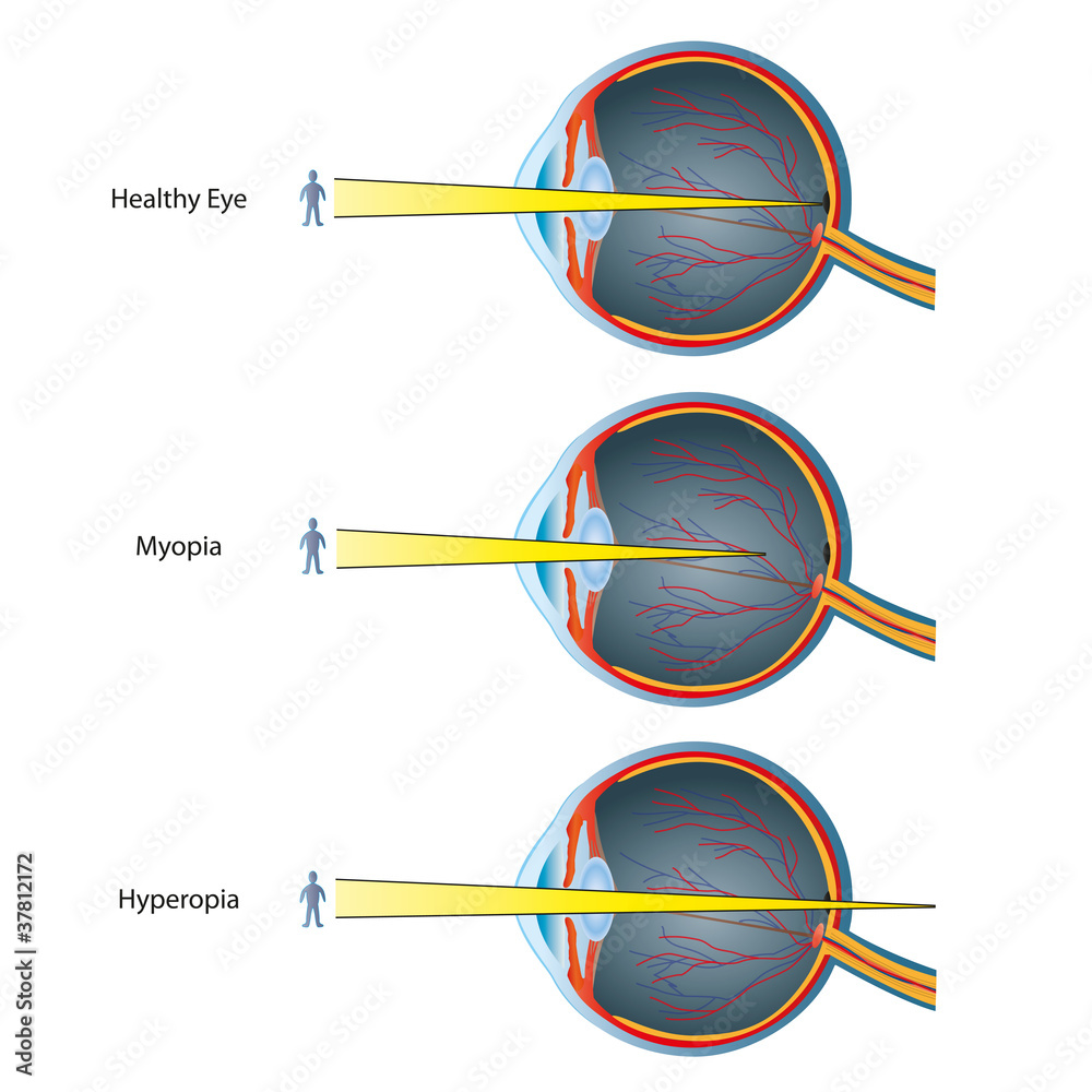 myopia and hyperopia vektor illustration Stock Vector | Adobe Stock
