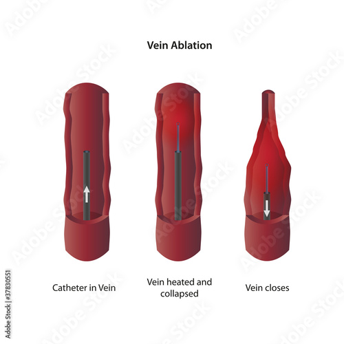 фотографія Vein ablation eps10 vector illustration