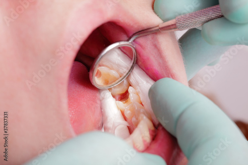Canvas Print Dental, tooth cavity in closeup