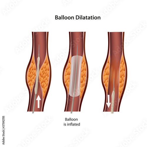 ballon dilatation eps vector illustration
