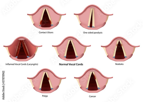 vocal cords findings vector illustration