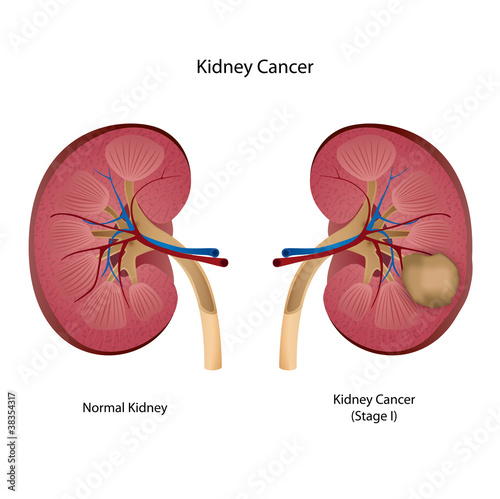 kidney cancer medical vector illustration english