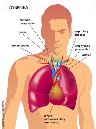 dispnea