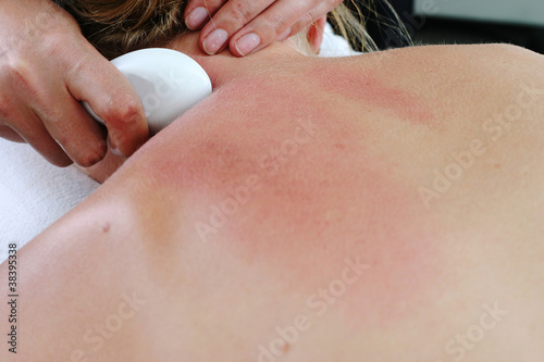 Gua Sha treatment photo