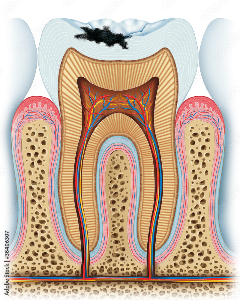 tooth caries