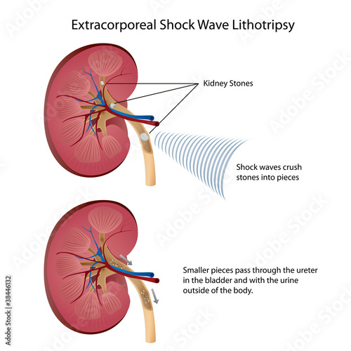 kidney ultra shock lithotripsy vector illustration