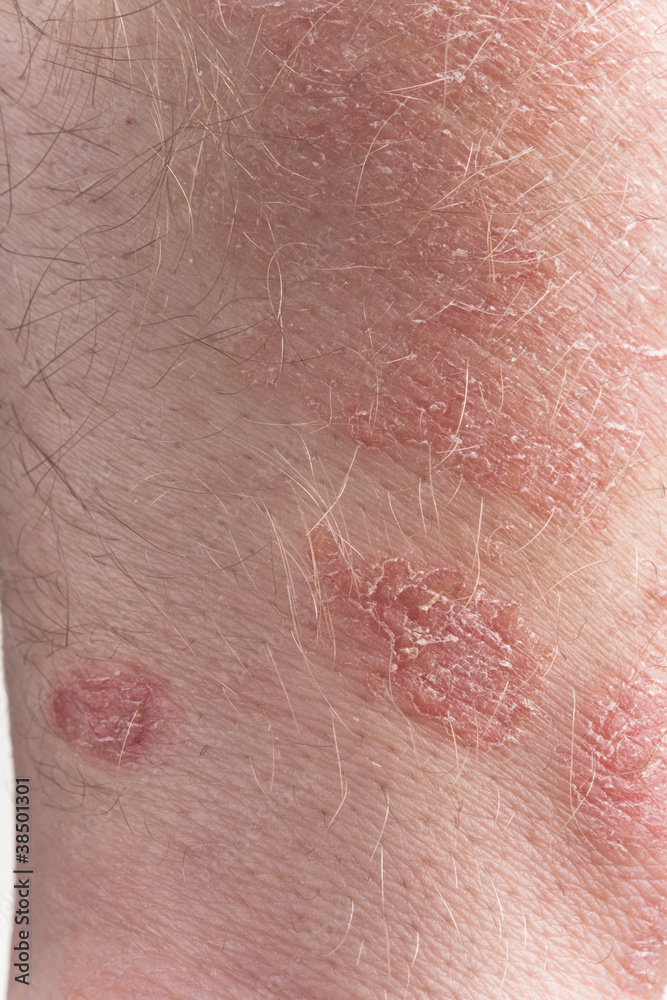 Fototapeta premium Psoriasis close-up