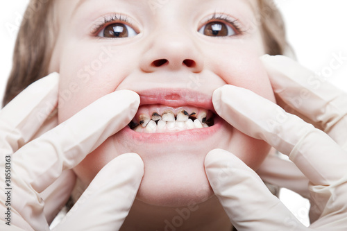 Fototapeta Caries teeth decay