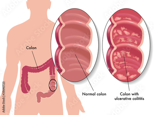 colite ulcerosa photo