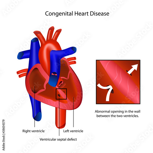 congenital heart disease medical vector illustration