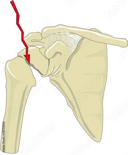Schulterfraktur