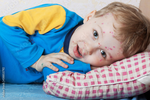 Boy suffers chickenpox photo