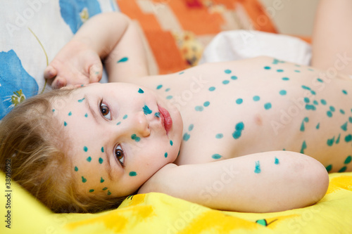 Little child with varicella zoster virus illness.