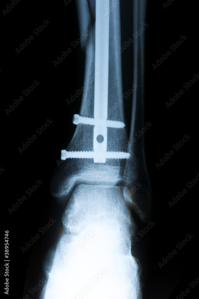 Röntgenbild Fraktur Bein mit Schrauben Stock-Foto | Adobe Stock