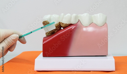 Gums and teeth with tartar photo