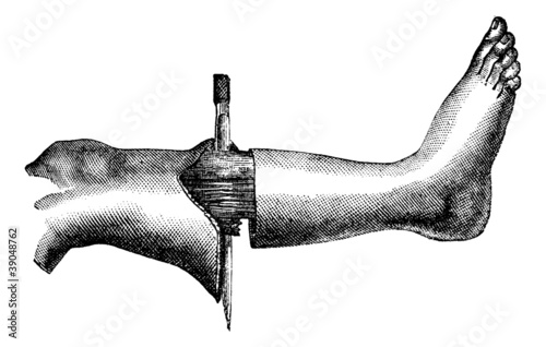 Amputation of the leg by the method has two flaps (circular inci