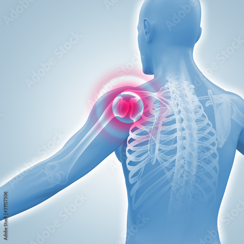 Schmerzen in der Schulter - Röntgenbild