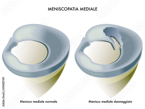 meniscopatia mediale
