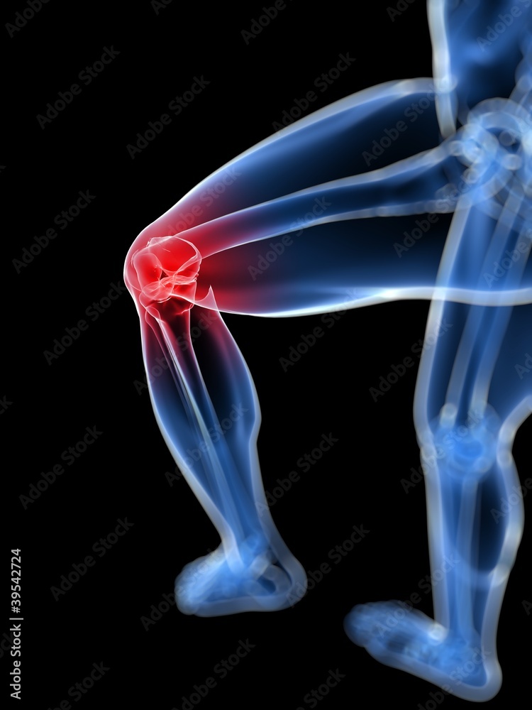 Schmerzendes Kniegelenk - Skelett