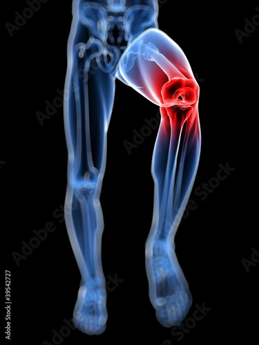 Schmerzendes Kniegelenk - Skelett