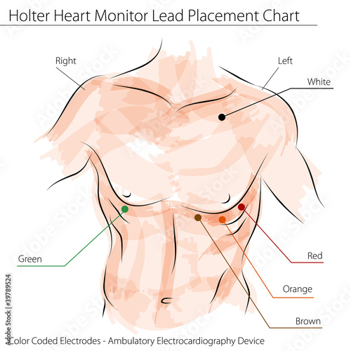 Holter Heart Monitor Lead Placement Chart