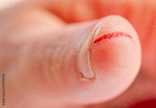 injured finger photo