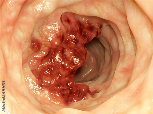 Darmtumor / intestine tumor photo