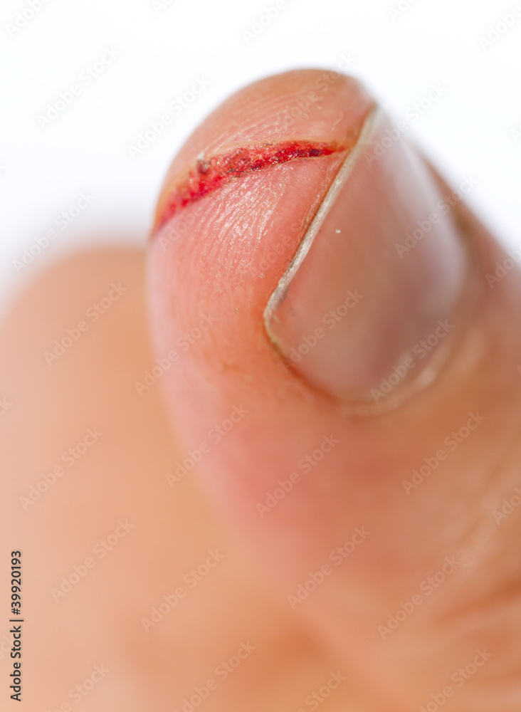 Fototapeta premium injured finger