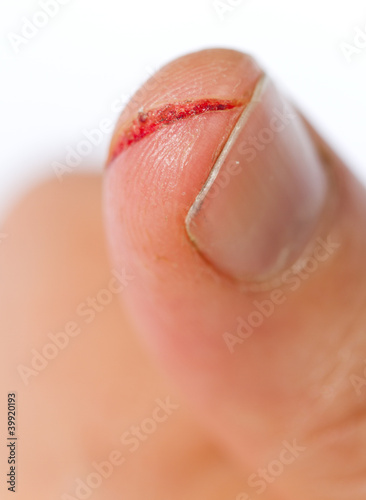 injured finger
