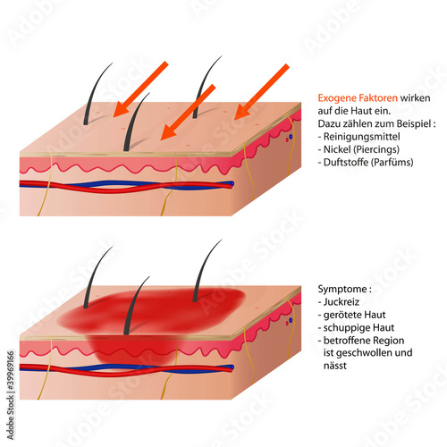 allergisches kontakt ekzem vektor illustration