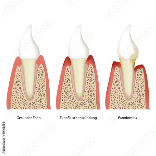 parodontitis tooth plaque vector illustration