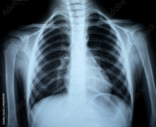 Chest xray