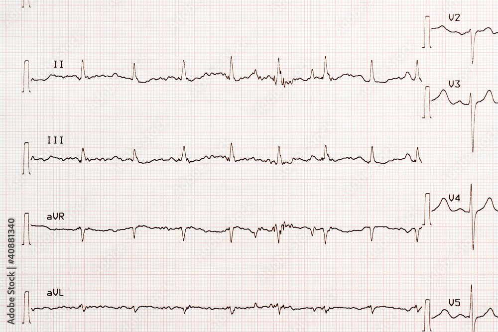 électrocardiogramme électrocardiogramme