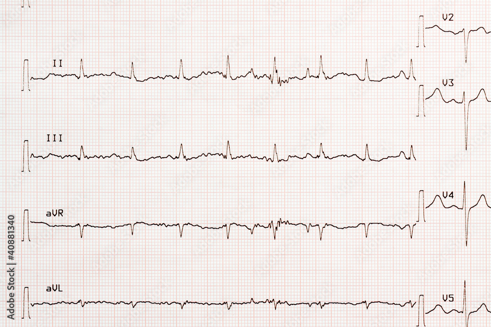 électrocardiogramme