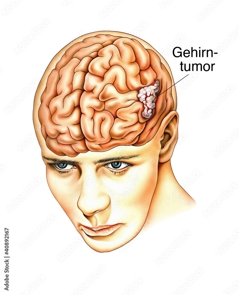 Gehirntumor.Gewebswucherung Stock-Illustration | Adobe Stock