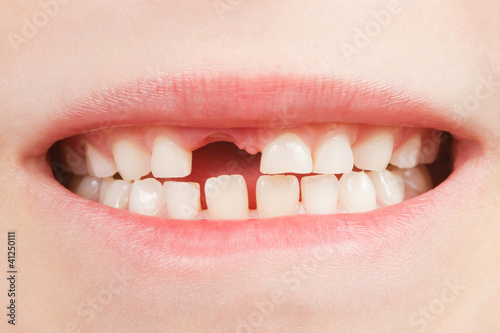 Kind mit Zahnlücke