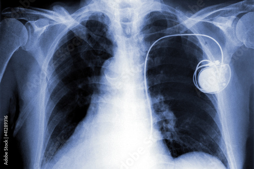 x-rays film