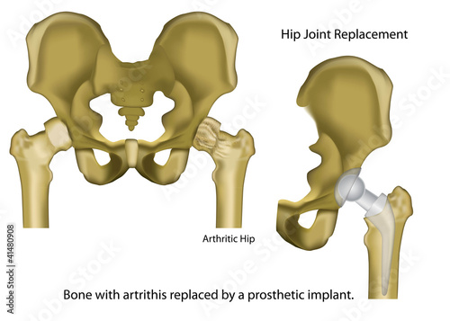 hip joint replacement medical vector illustration