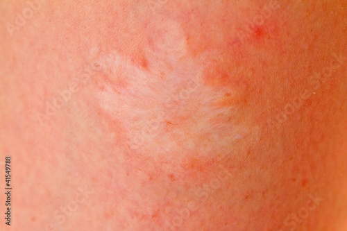 scar closeup
