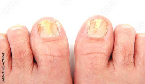 Toenails infected with a fungus photo