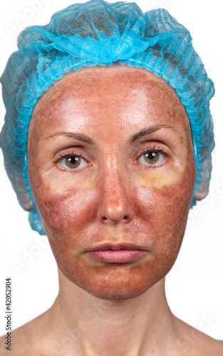 Cosmetology. Skin condition after chemical peeling TCA. photo