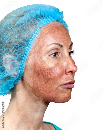 Cosmetology.Skin condition after chemical peeling TCA. photo