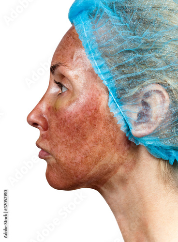 Cosmetology.Skin condition after chemical peeling TCA. photo