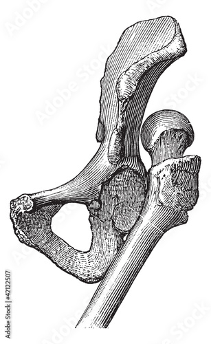 Dislocation of the hip, vintage engraving.