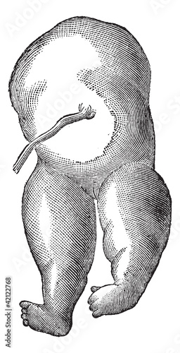 Fig. 36. Acephaly a type of cephalic disorder, vintage engraving